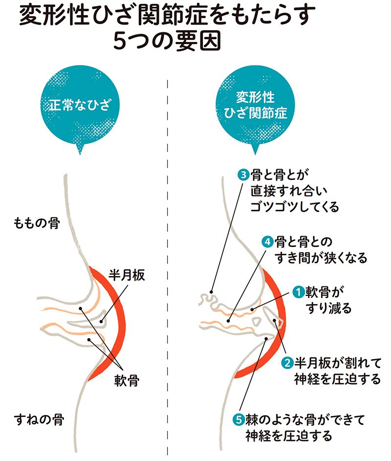 2ページ目）起き抜けに体を動かすと、ひざや股にこわばり…軟骨すり減っ