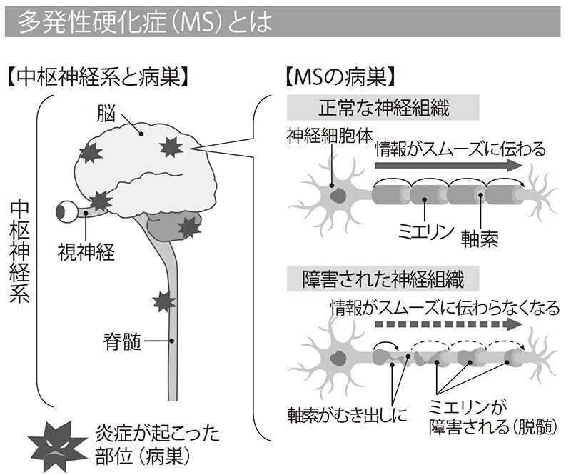  MSの症状を悪化させるものは何ですか?