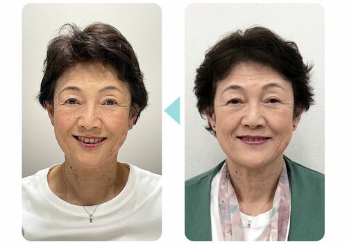 表情筋トレーニング